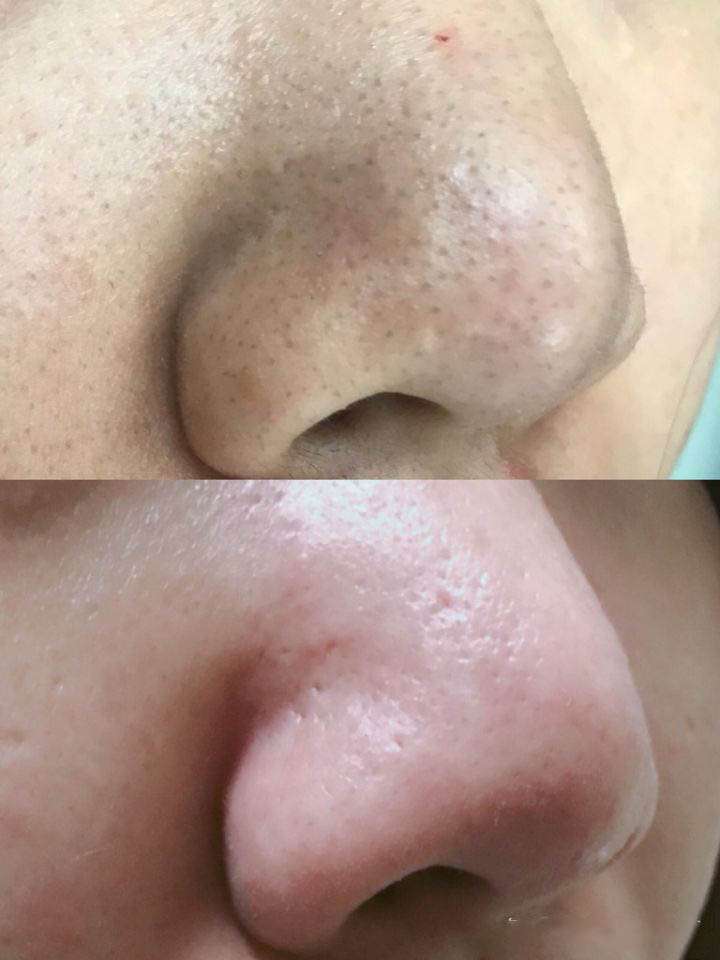 吸黑头仪可以用吗会不会导致毛孔粗大