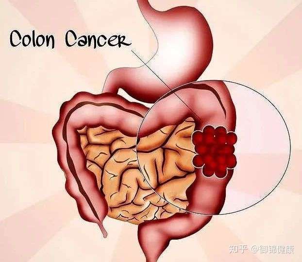 左下腹疼 有哪些常见的病因 知乎