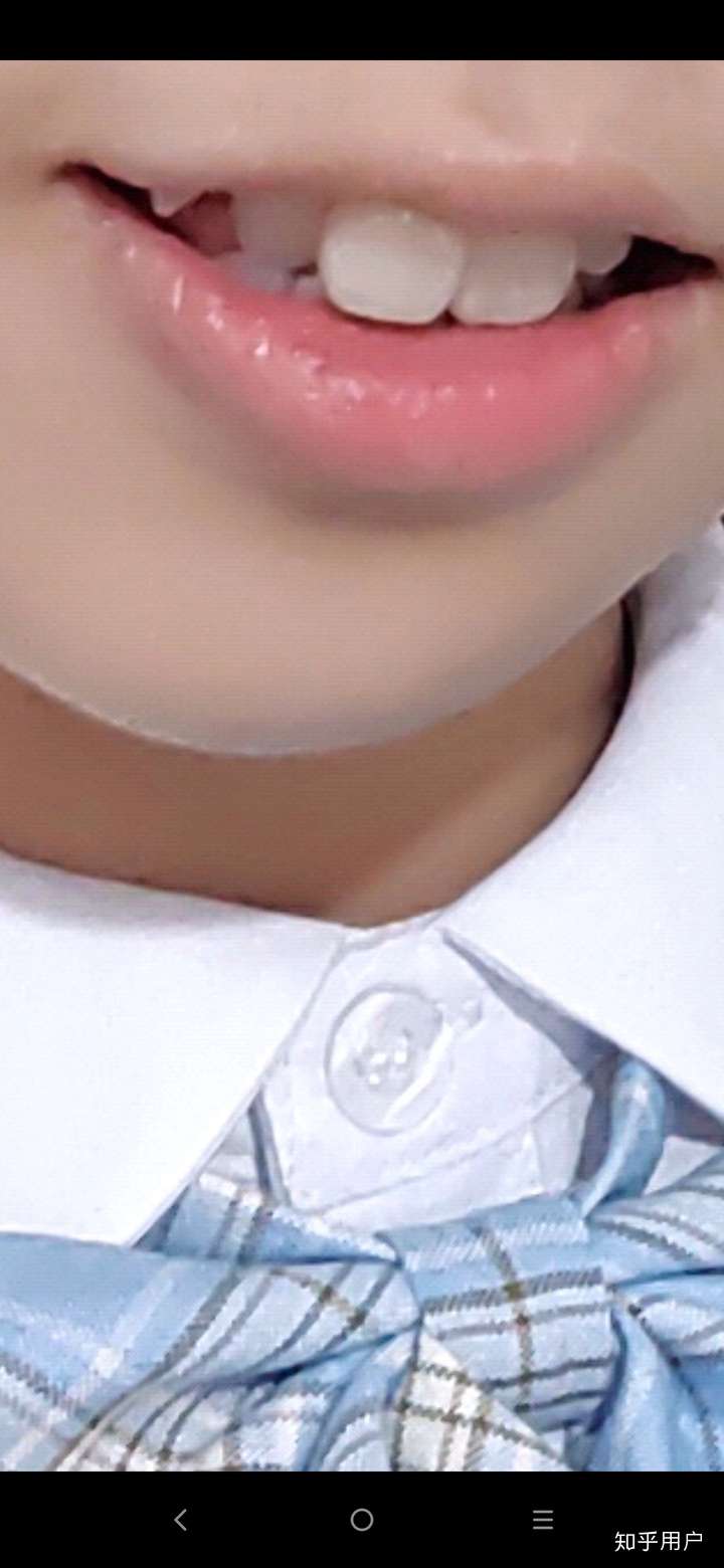 一个人同时长有虎牙和兔牙是什么样的感受?