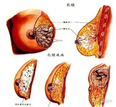 乳腺结节是怎么产生的图片