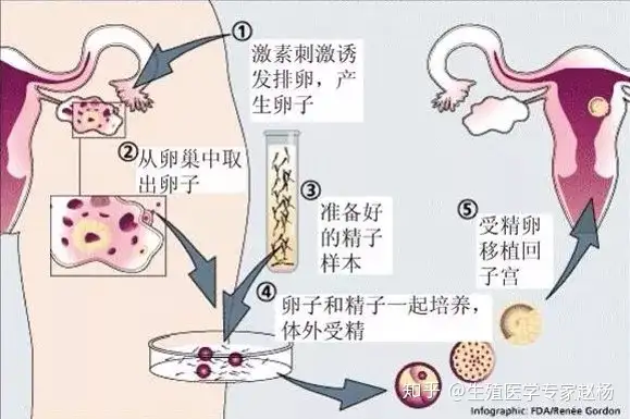成都借卵（做试管婴儿的流程，最真实的身体感受！）