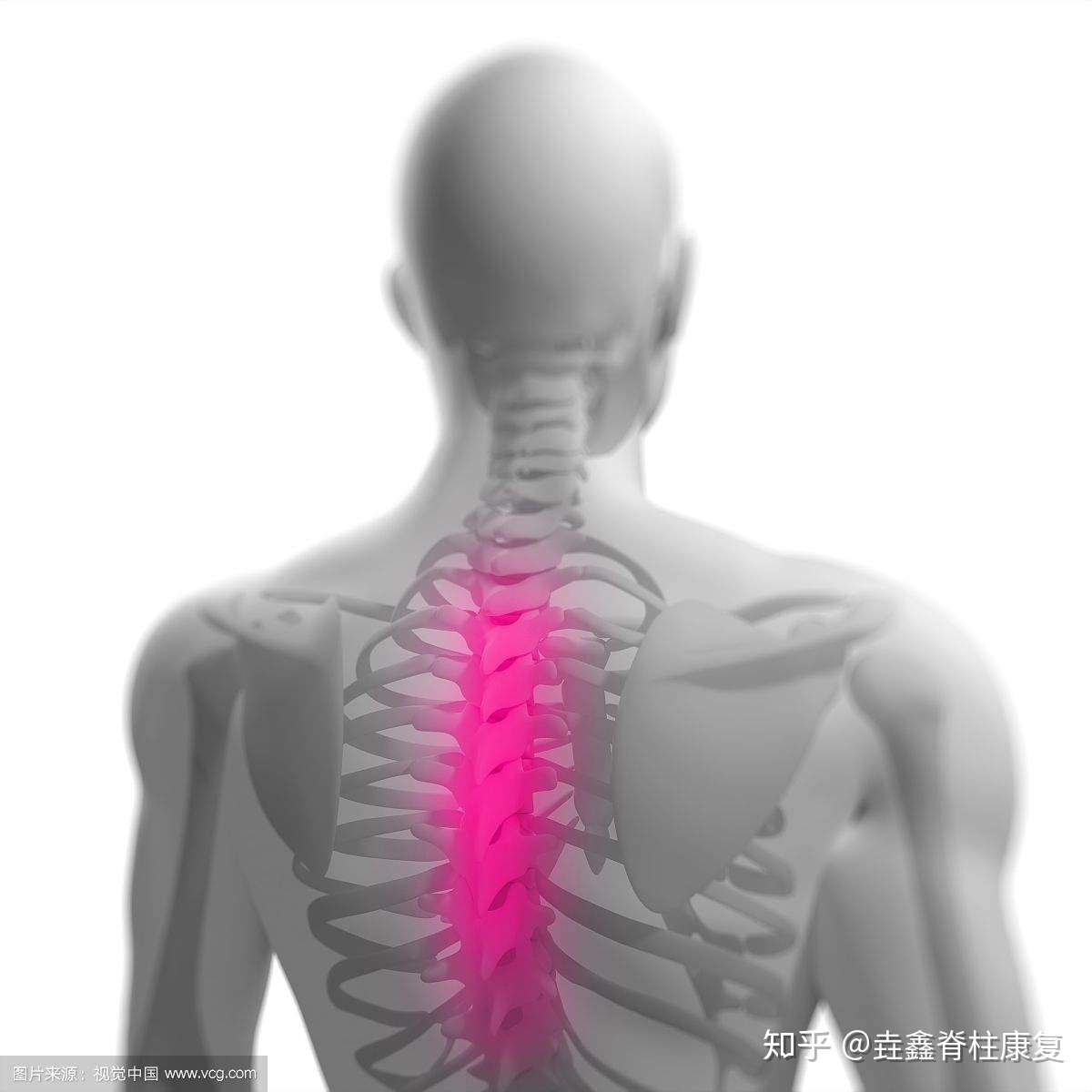 腰肌劳损 背部筋膜炎 背痛原因及康复方法 知乎