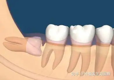 智齒一般會在16-36歲之間萌出,人類的第三磨牙.