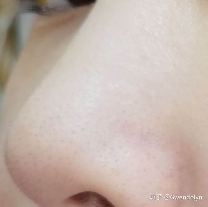 请问这种黑头如何去除!