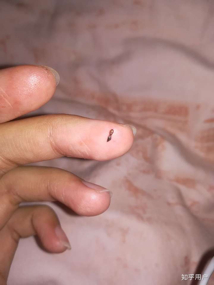 为什么在身体皮肤上可以抠出一颗和圆珠笔头大小的很硬的黑色东西?