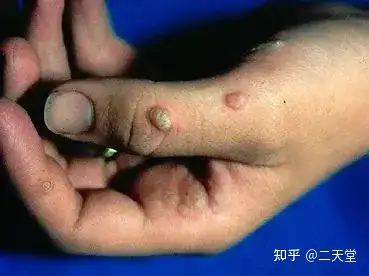 丝状疣是寻常疣的特殊类型,好发于眼睑和颈部,表现为细长的丝状突起
