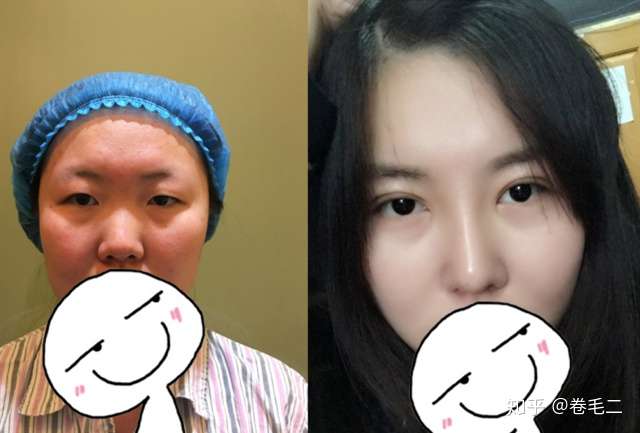 缩鼻头鼻翼是什么样的体验?手术前应该注意什么?