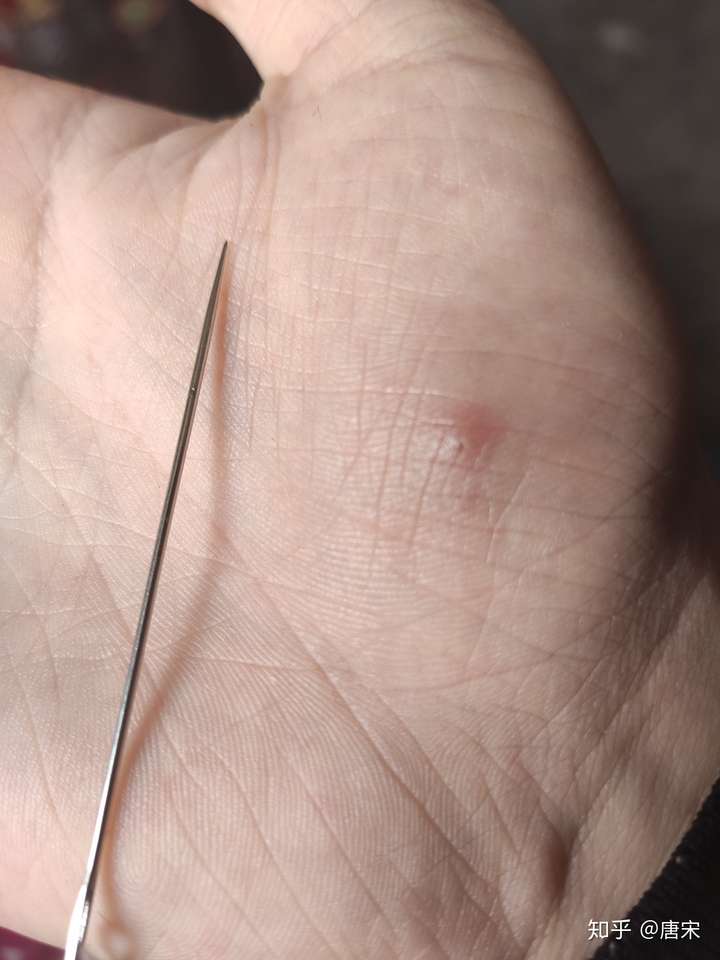 如何用一根针挑出肉中刺?