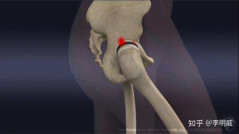 髋关节弹响怎么自己修复?