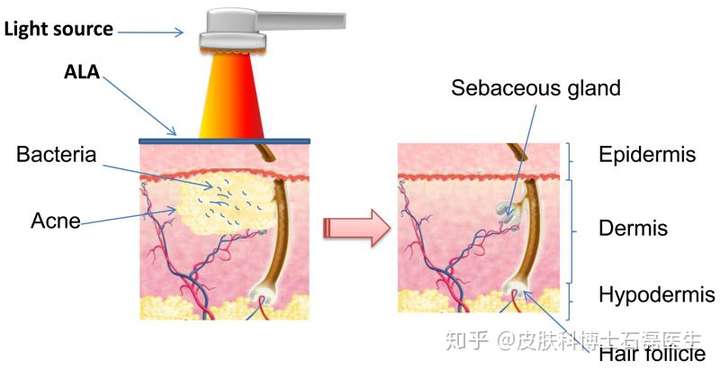 acid photodynamic therapy,ala-pdt)用于临床治疗皮肤基底细胞癌