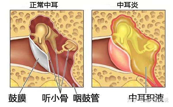 首大李希平 中耳炎的九大误区 你知道几个 知乎