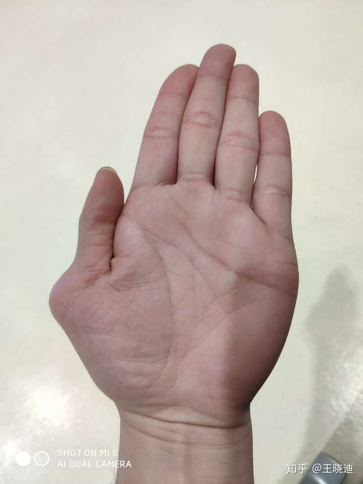 一只手有六个手指是种怎样的体验?