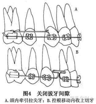 正畸一类牵引示意图图片