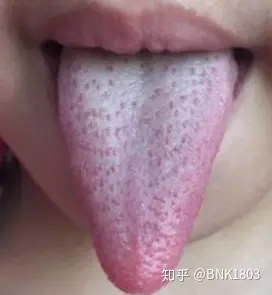 小儿草莓舌头图片图片