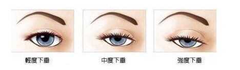 上睑下垂如果不做提肌只割双眼皮会是什么样的?