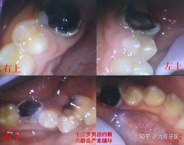 六龄牙坏了怎么办图片