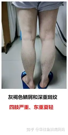皮肤起皮屑像鱼鳞怎么回事 知乎