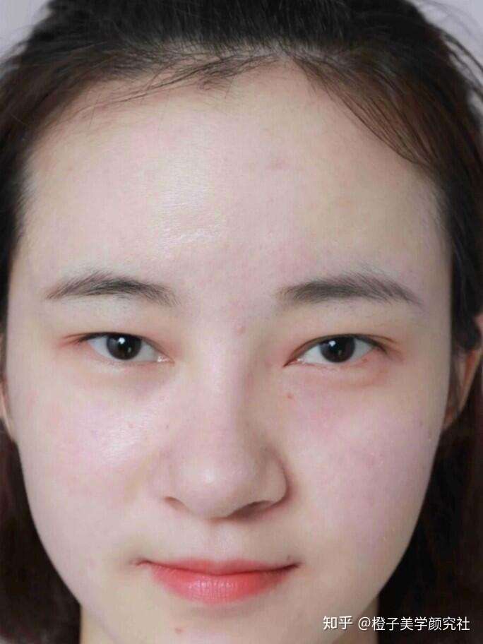 收割妈生双眼皮史上最强双眼皮术前准备