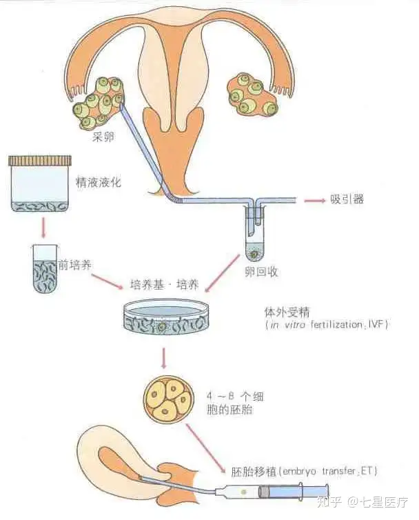 上海助孕哪家好（试管婴儿主要流程详解）