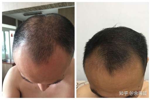 脱发治疗新方向 血流可能是决定毛囊健康的重要因素 知乎