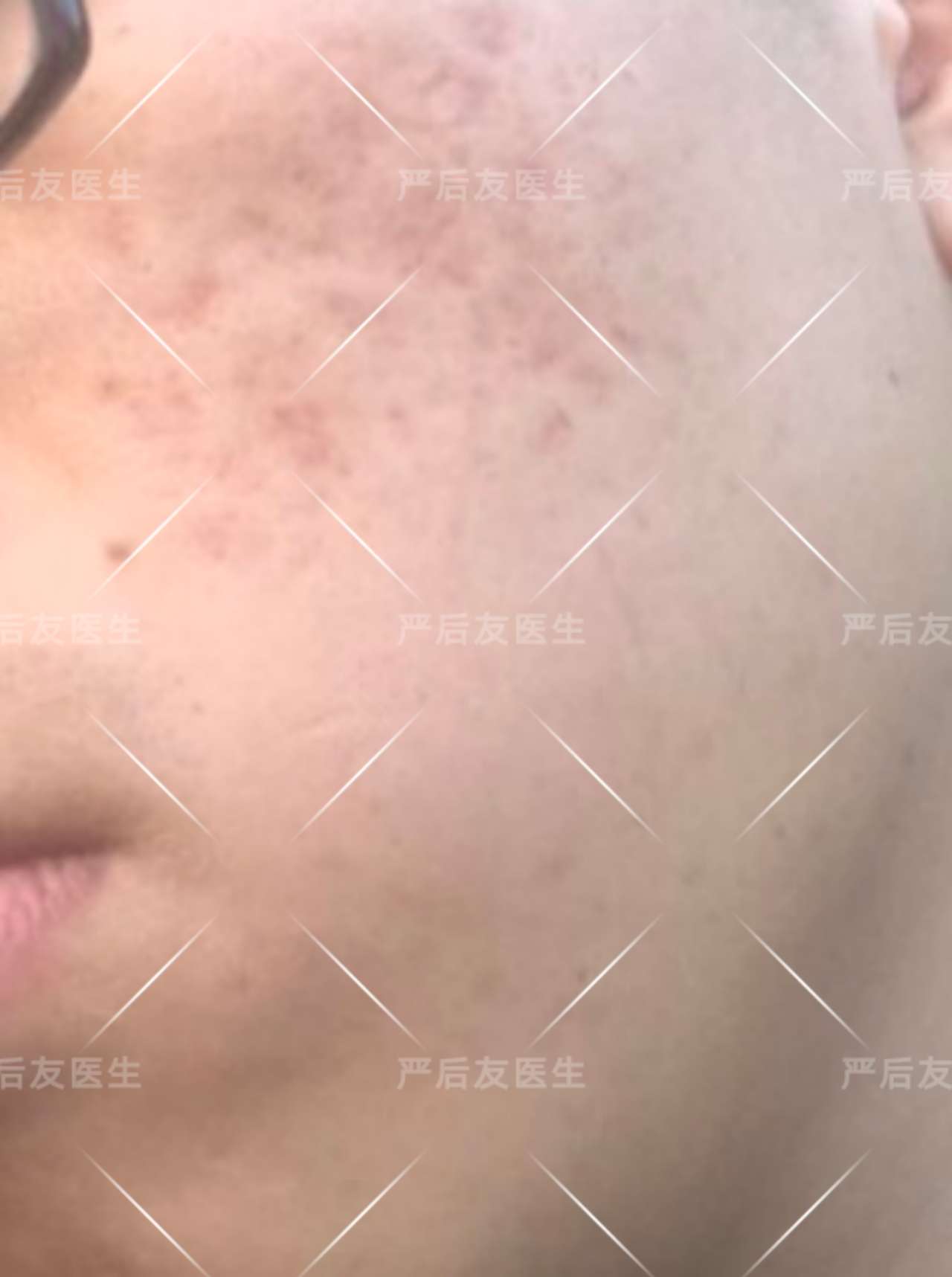 重度四级痤疮治疗一例