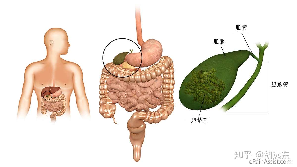 高中生喝奶茶得胆囊炎 这事未必怪 珍珠 知乎