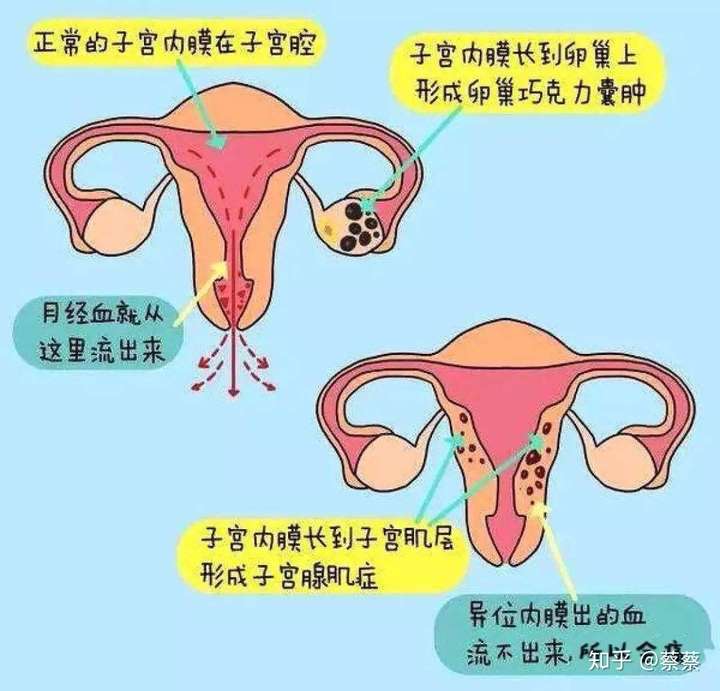 子宫内膜位置图片图片