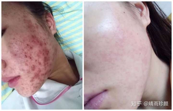 痘痘肌,敏感肌用什么护肤品好?