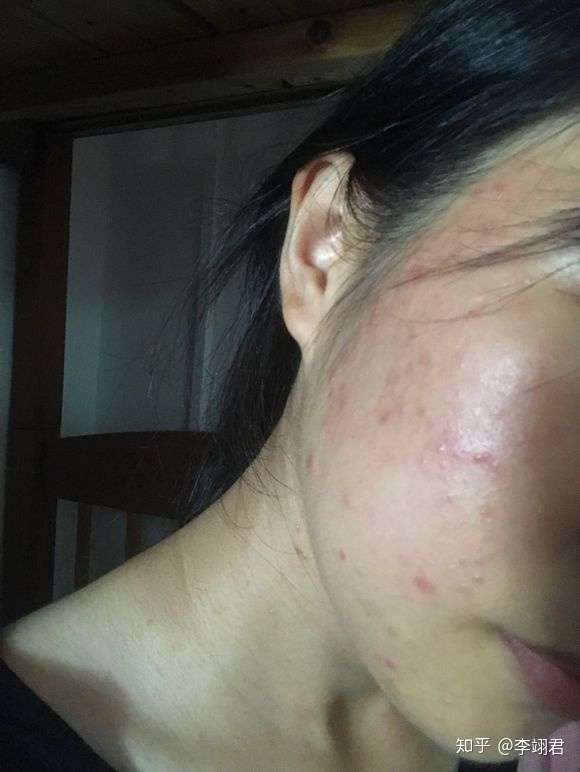 痘痘成熟后变得白白的洗脸的时候破了怎么办该如何科学处理