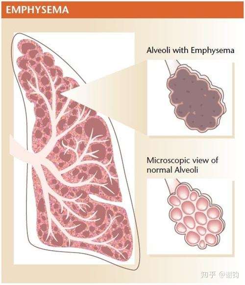主要致死原因是,在通过人体呼吸道进入肺部之后,大量繁殖并侵犯肺细胞
