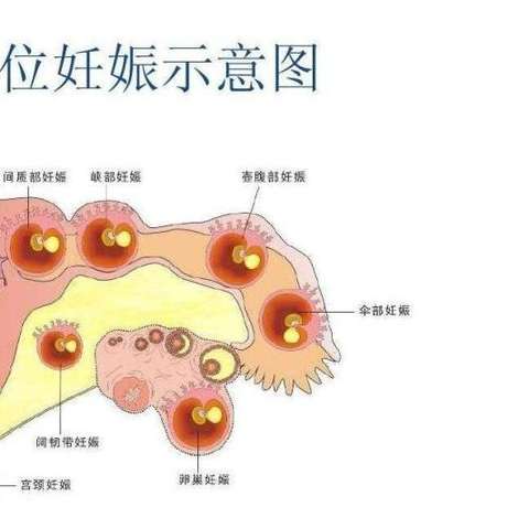 异位妊娠图片部位图片