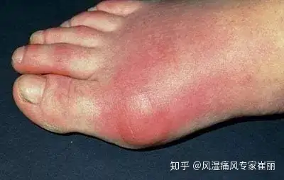 痛风患者必须知道的事发作期治好痛风不再反复发作