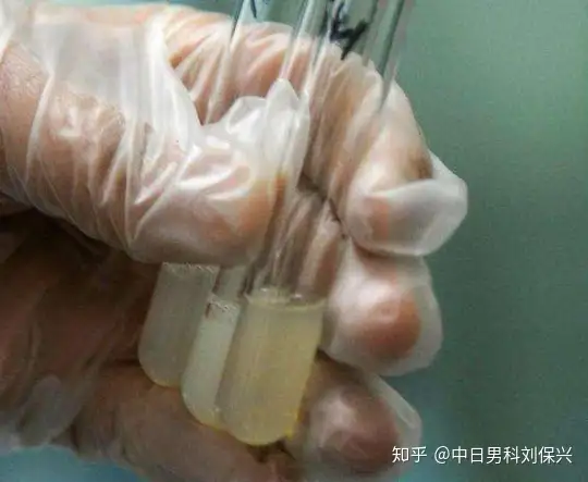 广州供卵自怀（刘保兴科普：男性不孕相关检查，哪些项目属于精液检查？）