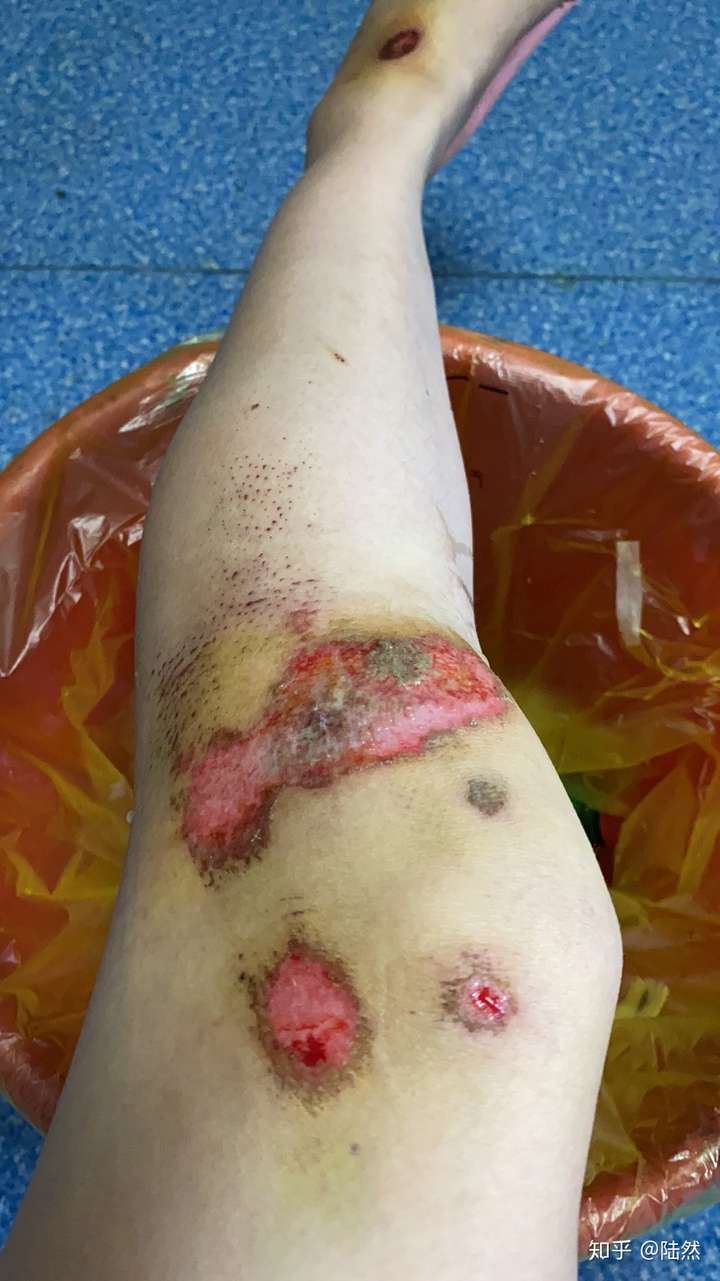 骑车擦伤会不会留疤