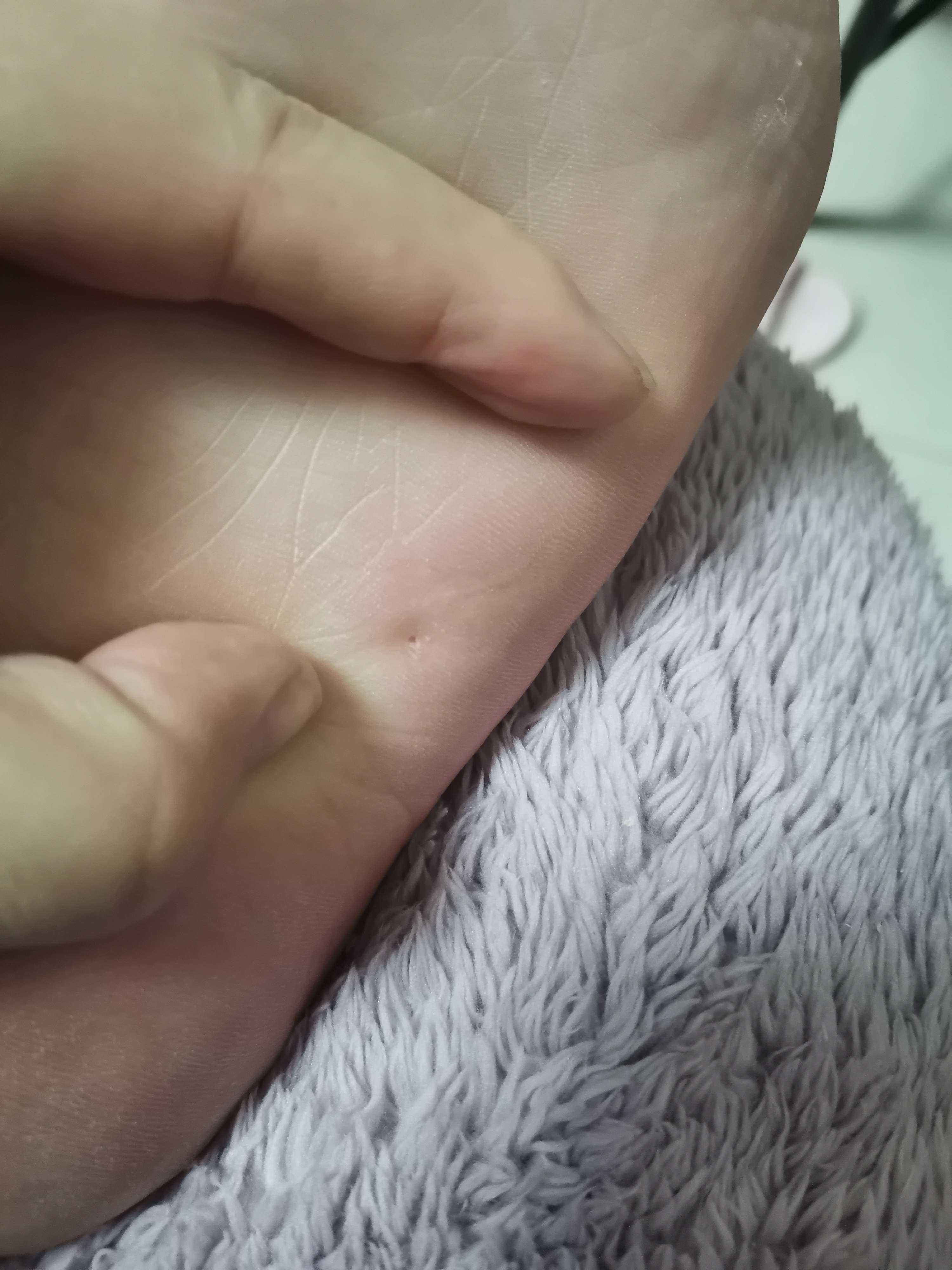 嘿未来 的想法: 这脚底那为什么会有个针眼,也不疼,请问
