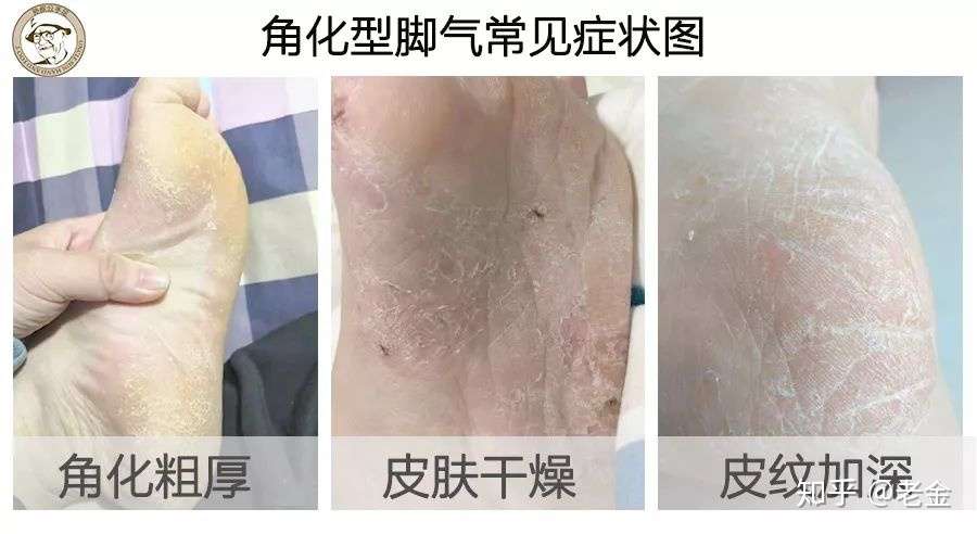 科普 足部皮肤最大的危害 脚气 知乎