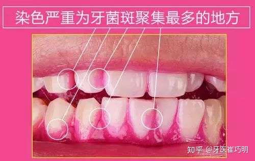 "今天,教大家自己检测口腔中牙菌斑的方法!