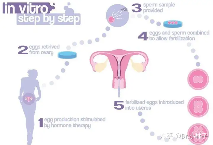 成都供卵费用（试管婴儿全过程是怎样的？什么是试管婴儿？）
