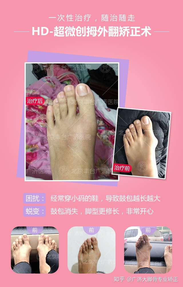 拇外翻治疗范围介绍 知乎 拇外翻治疗范围介绍 知乎