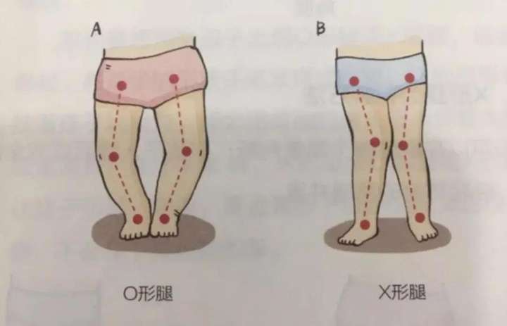 婴儿下肢剪刀状图片图片