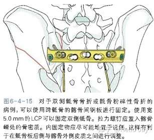 骨盆環損傷的治療原則