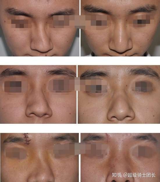 歪鼻矫正科普 歪鼻的类型有哪些 歪鼻矫正的手术方法和价格 知乎