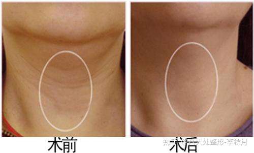 脖子脂肪多,从小就有颈纹得人怎么淡化颈纹呀?