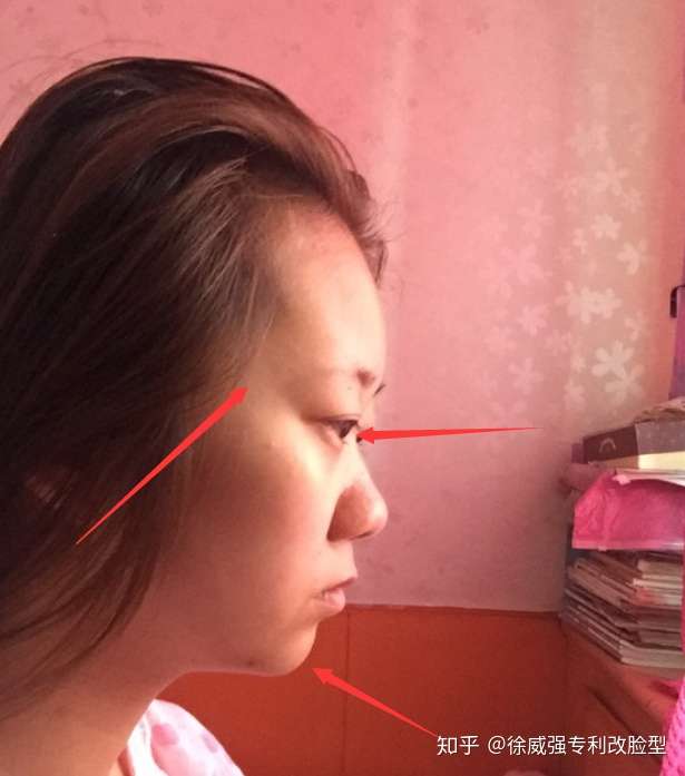 面部侧面看扁平怎么办