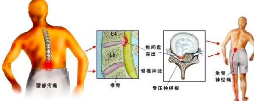 明明是腰椎间盘突出 为什么会腿疼 知乎 明明是腰椎间盘突出 为什么会腿疼 知乎