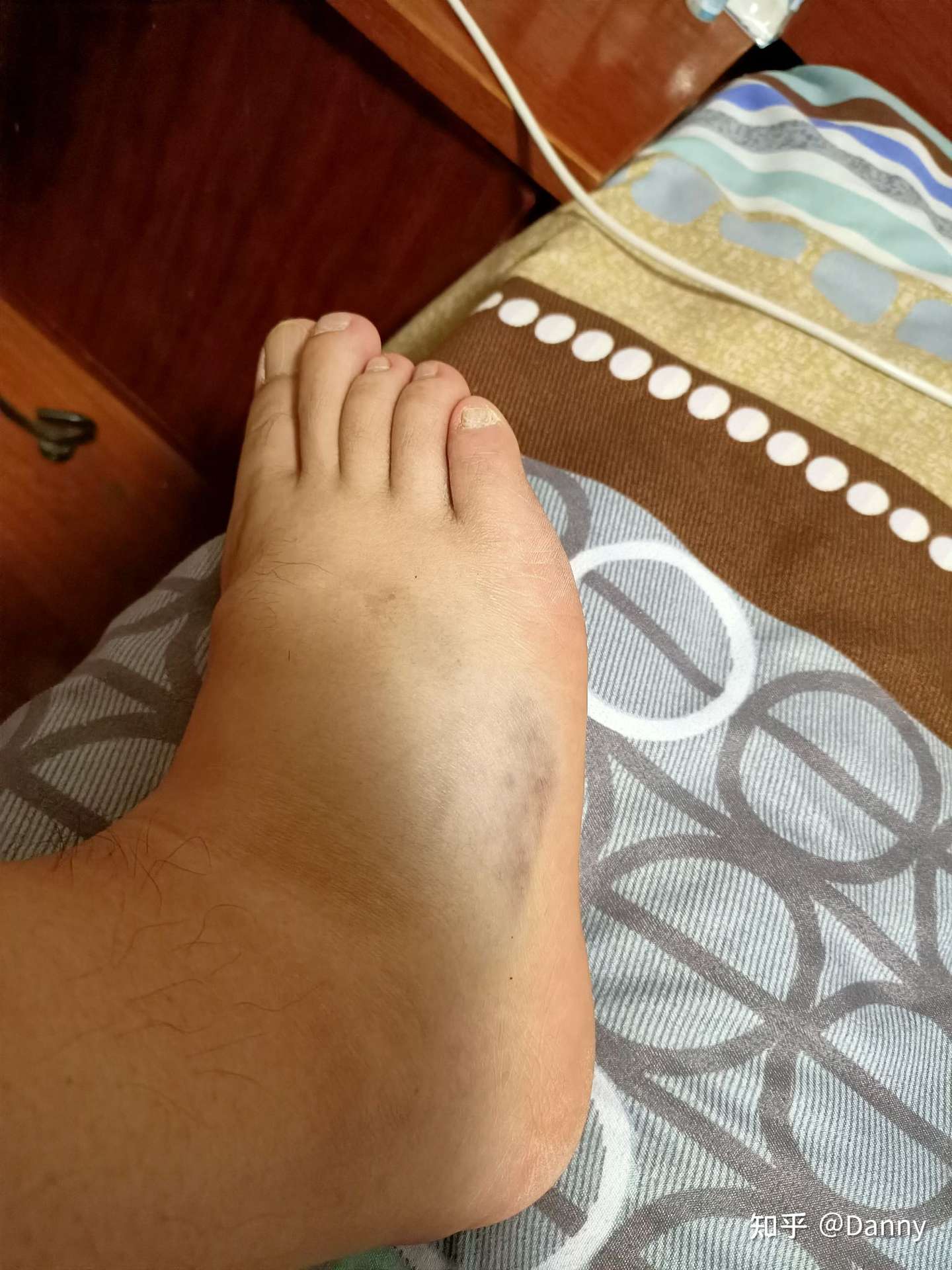 我的第五趾骨骨折记录 知乎