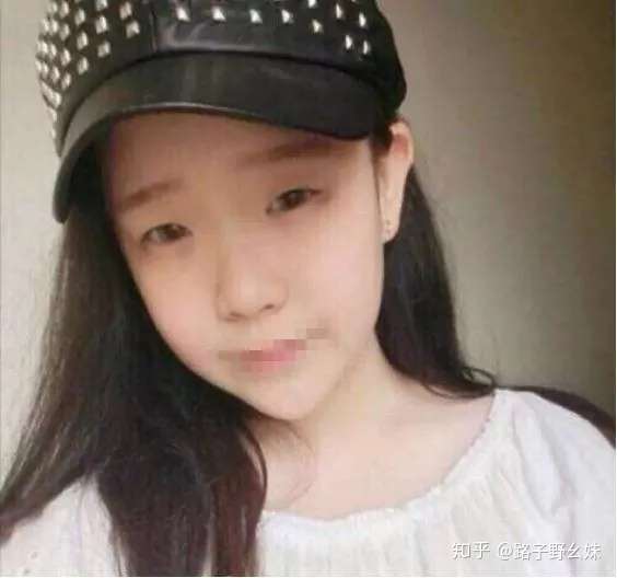 网红卵母细胞假体满天飞 脸没一处是真的 鼻头鼻尖一样高是整容后遗症 知乎