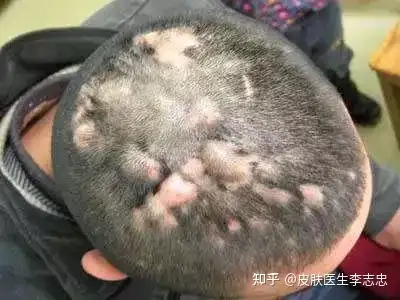 病因:现代医学认为,病因及发病机制目前尚不明确,认为主要与毛囊闭锁