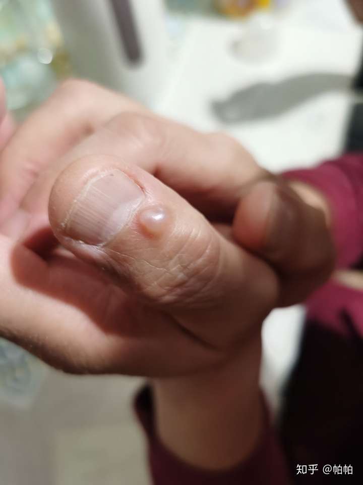 帕帕 设计师 家人大拇指上起了像水泡的症状,去医院看说是粘液囊
