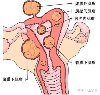 子宮肌瘤的症狀有哪些